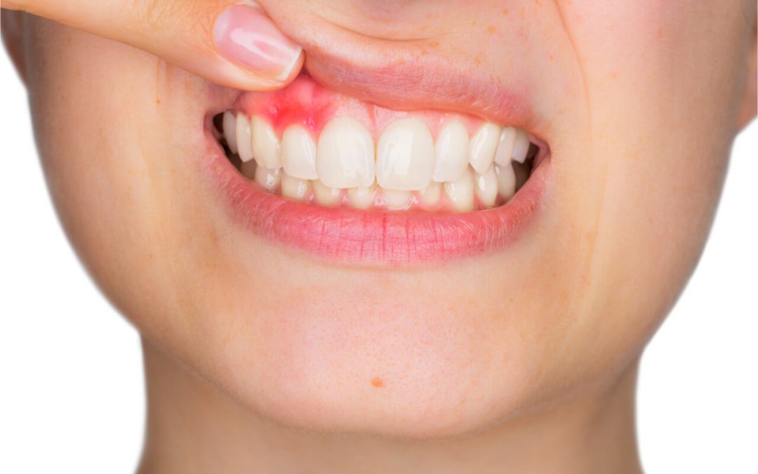 gum swell due to tooth abscess